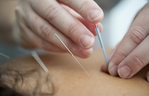 Moxibustion